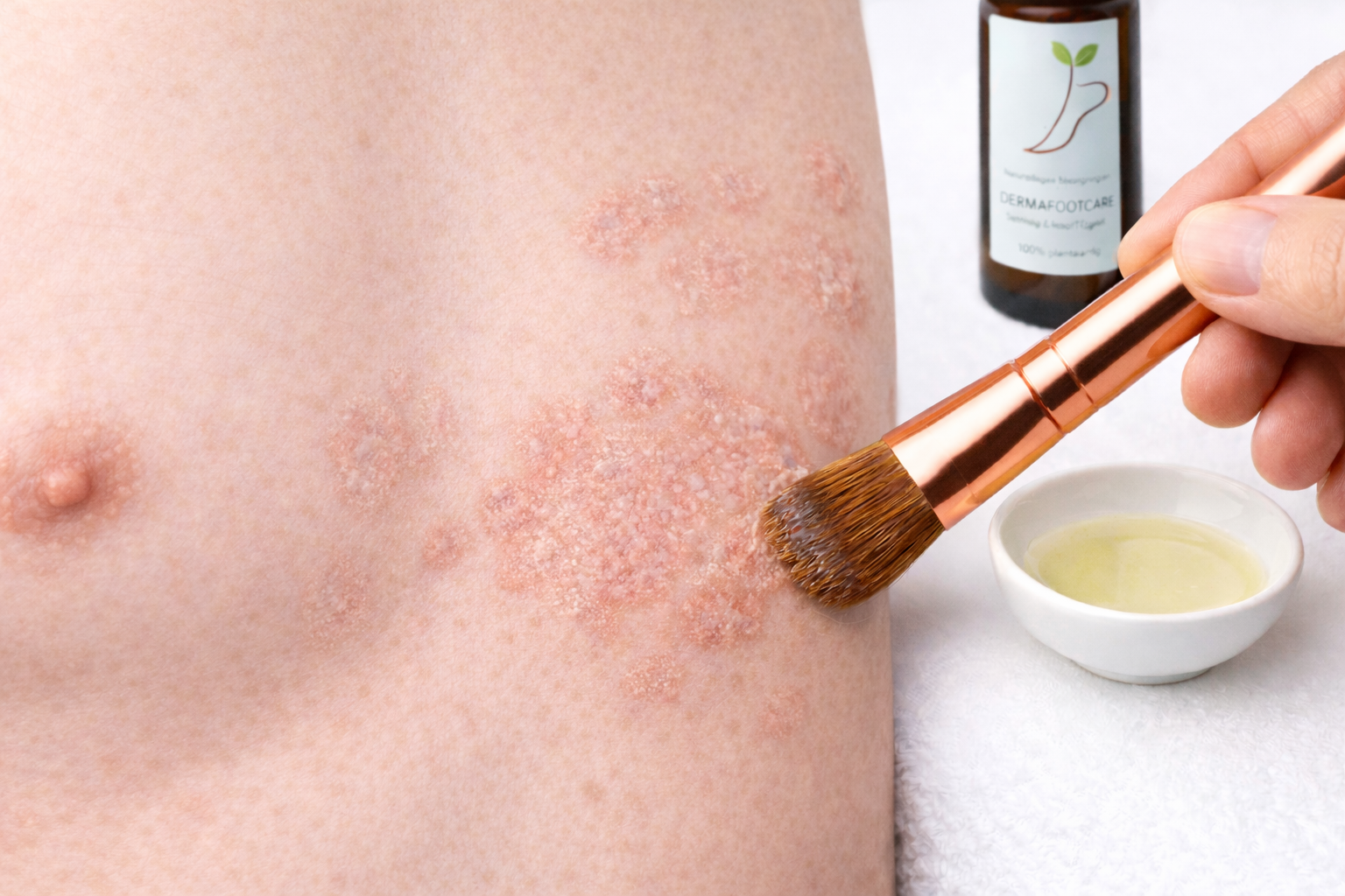 5-pack ringworm behandeling DermaFootCare met gratis verzending beste waarde

